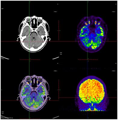 Metabolic assessment of cerebral palsy with normal clinical MRI using 18F-FDG PET imaging: A preliminary report